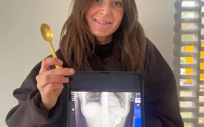 Đang ăn sữa chua, cô gái bất ngờ "nuốt trọn" chiếc thìa dài 17 cm