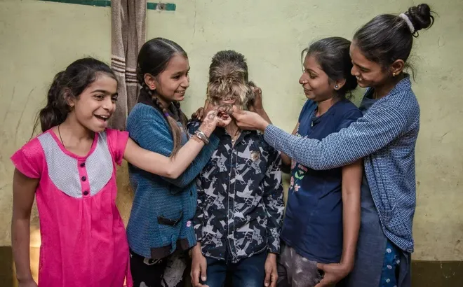 Từ cậu bé luôn bị trêu chọc, chàng trai này giờ được Guinness công nhận vì gương mặt đặc biệt