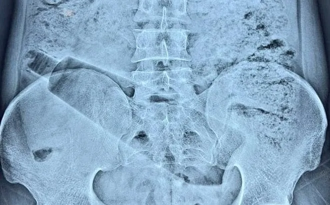 Đau bụng suốt 36 tiếng không rõ nguyên nhân, người đàn ông nhập viện và phát hiện điều khiến nhiều người bất ngờ