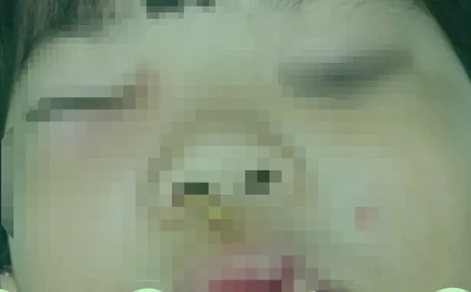 Thương tâm: Bé gái 5 tuổi bị que xiên thịt nướng đâm từ mũi tới hốc mắt